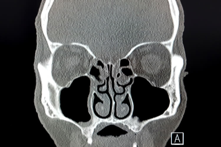 ct-scan-sinuses