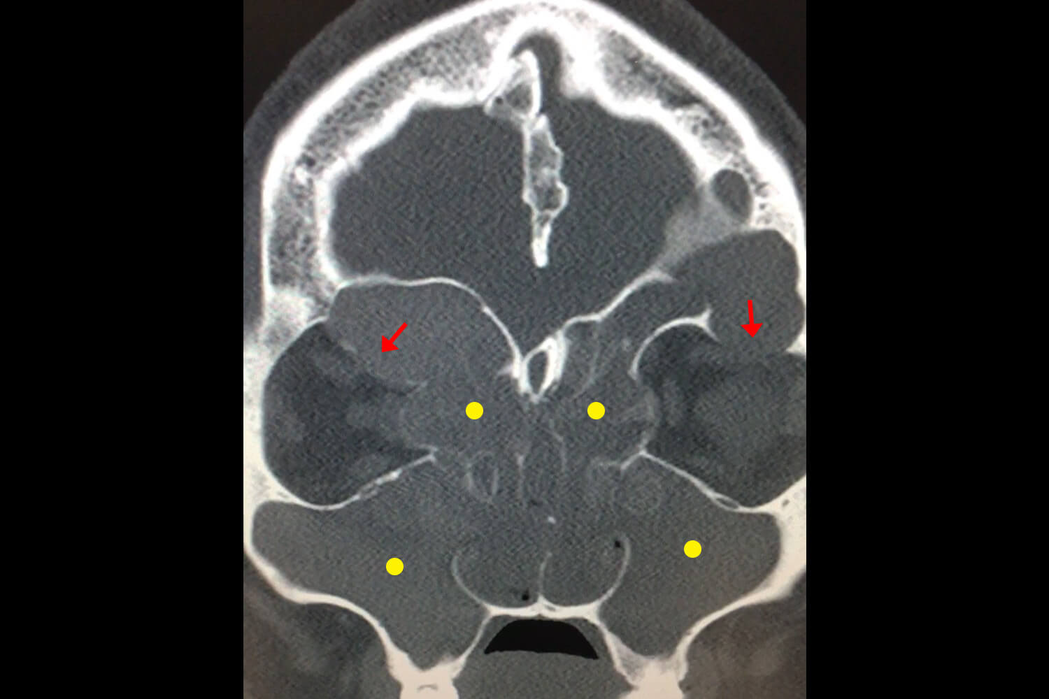 allergic-fungal-sinusitis-scan
