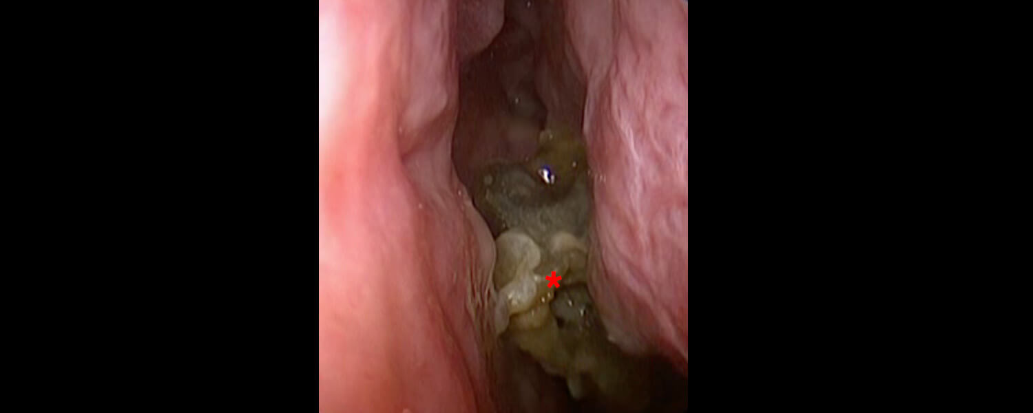 endoscopy-fungal-debris