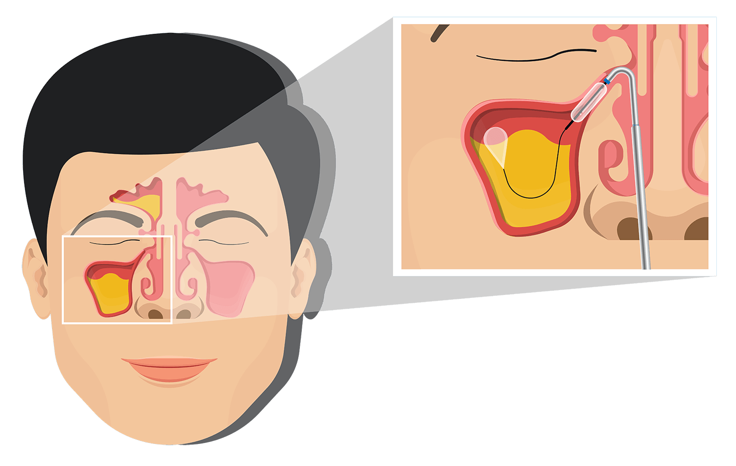 balloon-sinuplasty-diagram