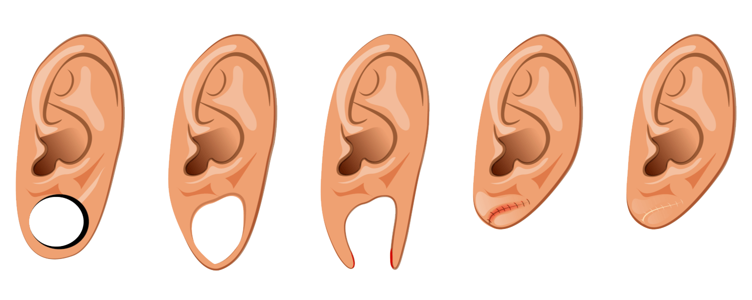 earlobe-repair