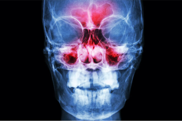 xray-frontal-maxillary-sinuses