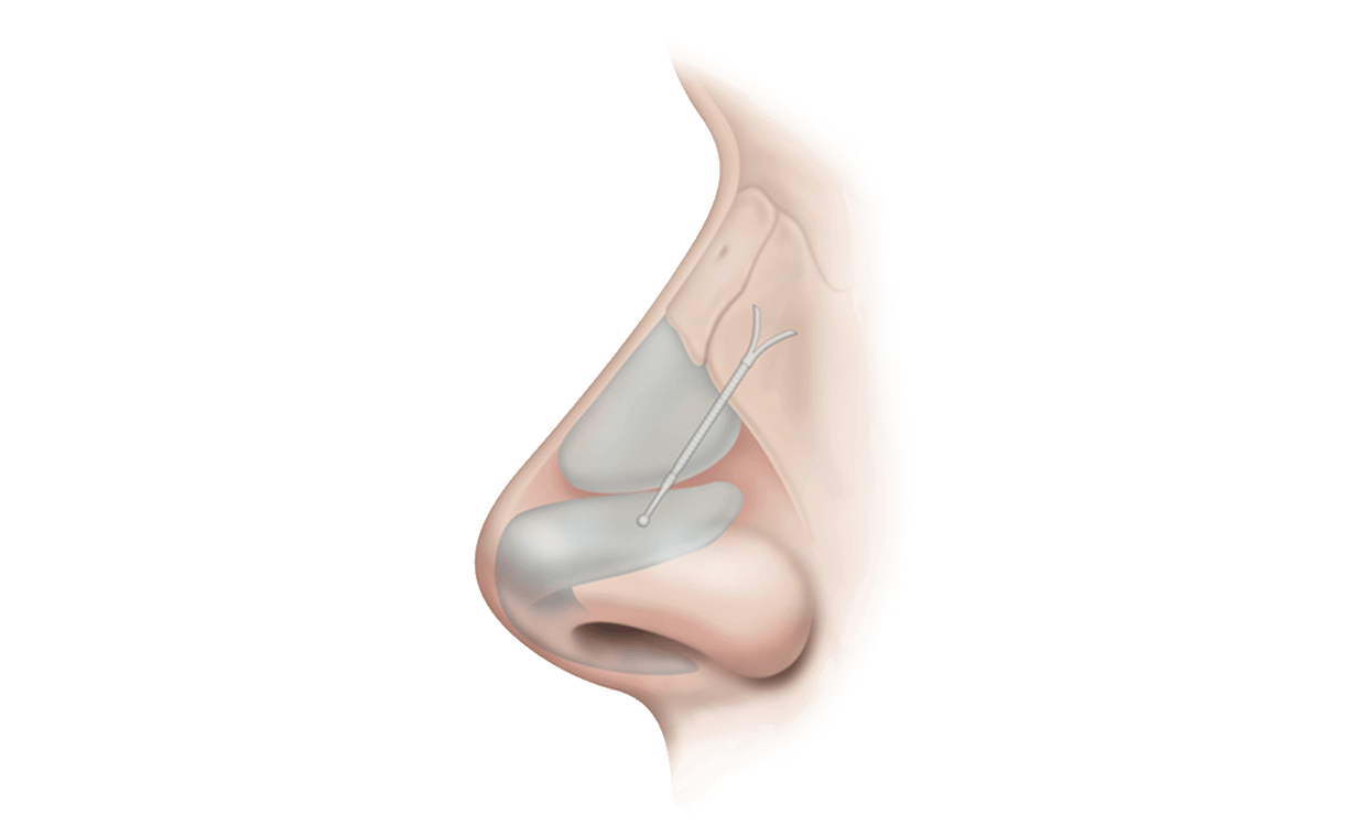 latera-diagram