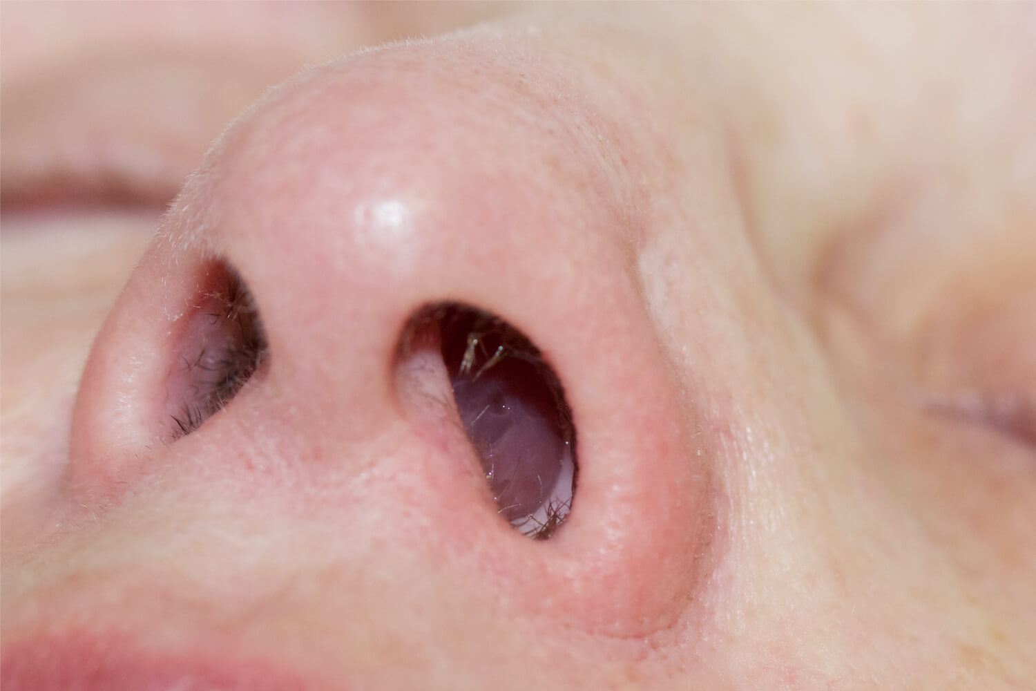 nasal-polyps