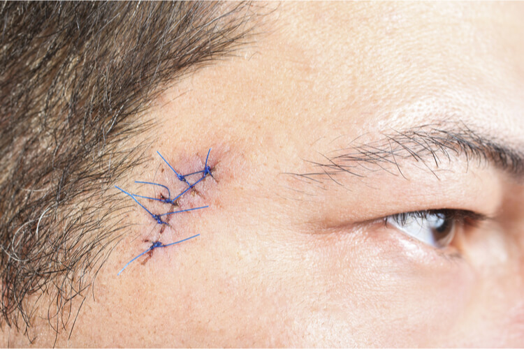 man-with-stitches