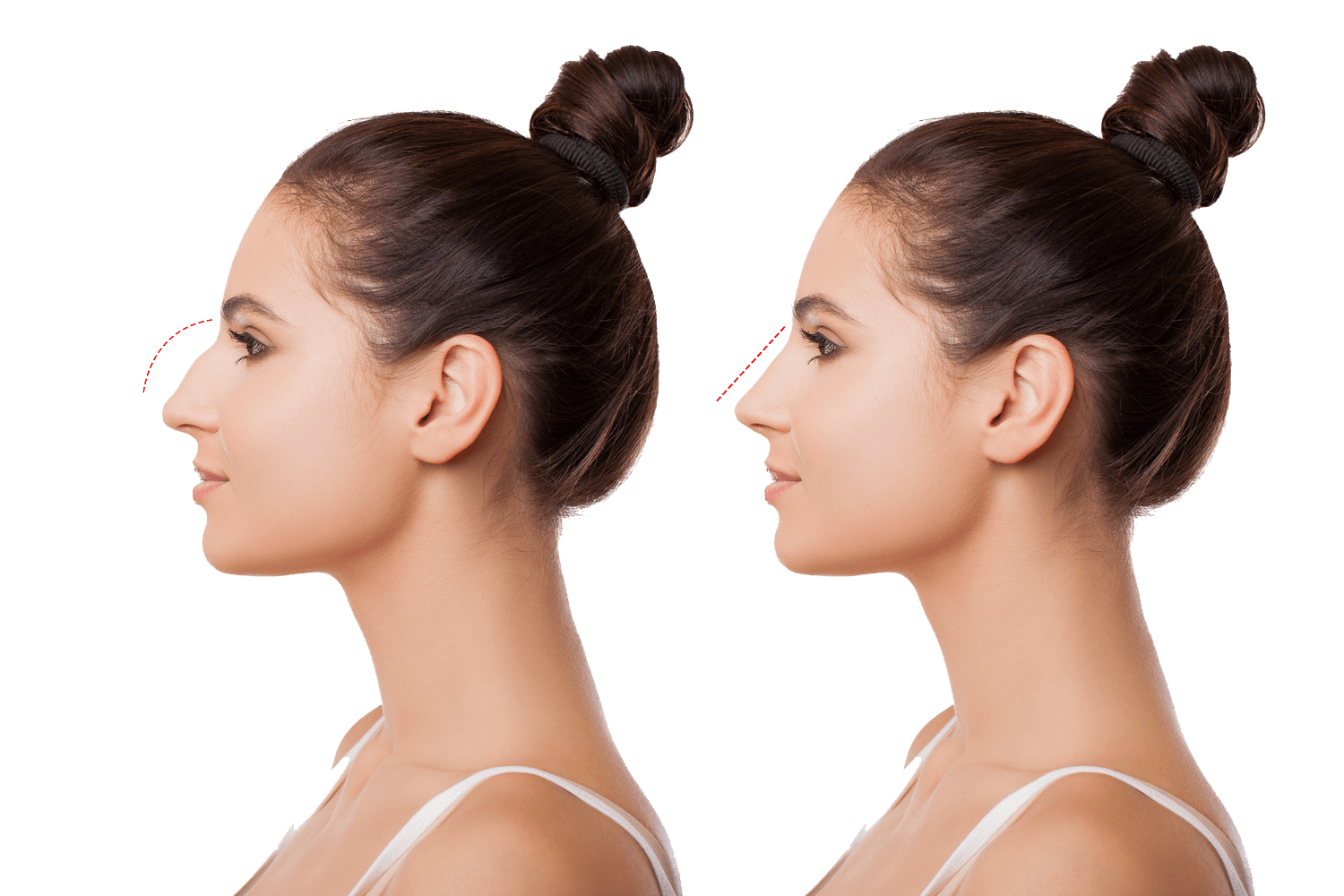 rhinoplasty-before-after
