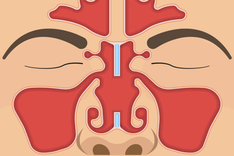 septal-perforation-diagram