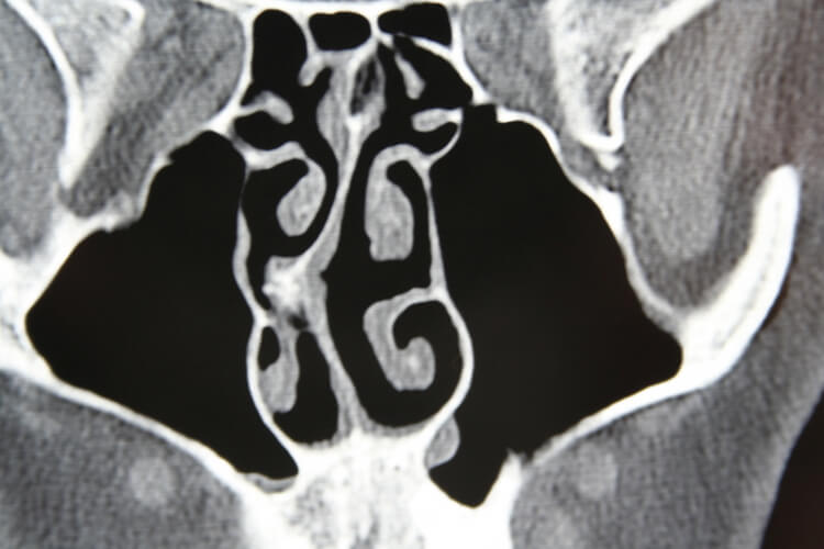 ct-scan-septum
