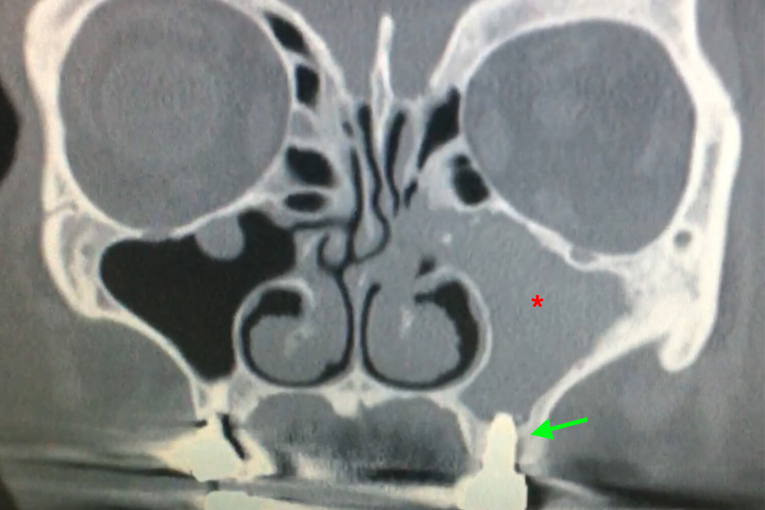 sinus-mucocele-scan