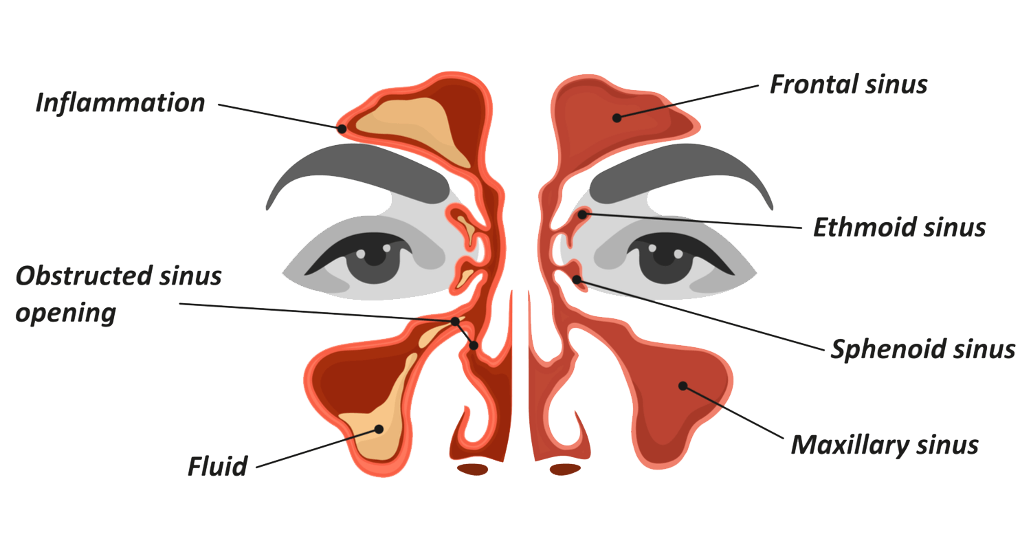 sinuses-anatomy-sinusitis