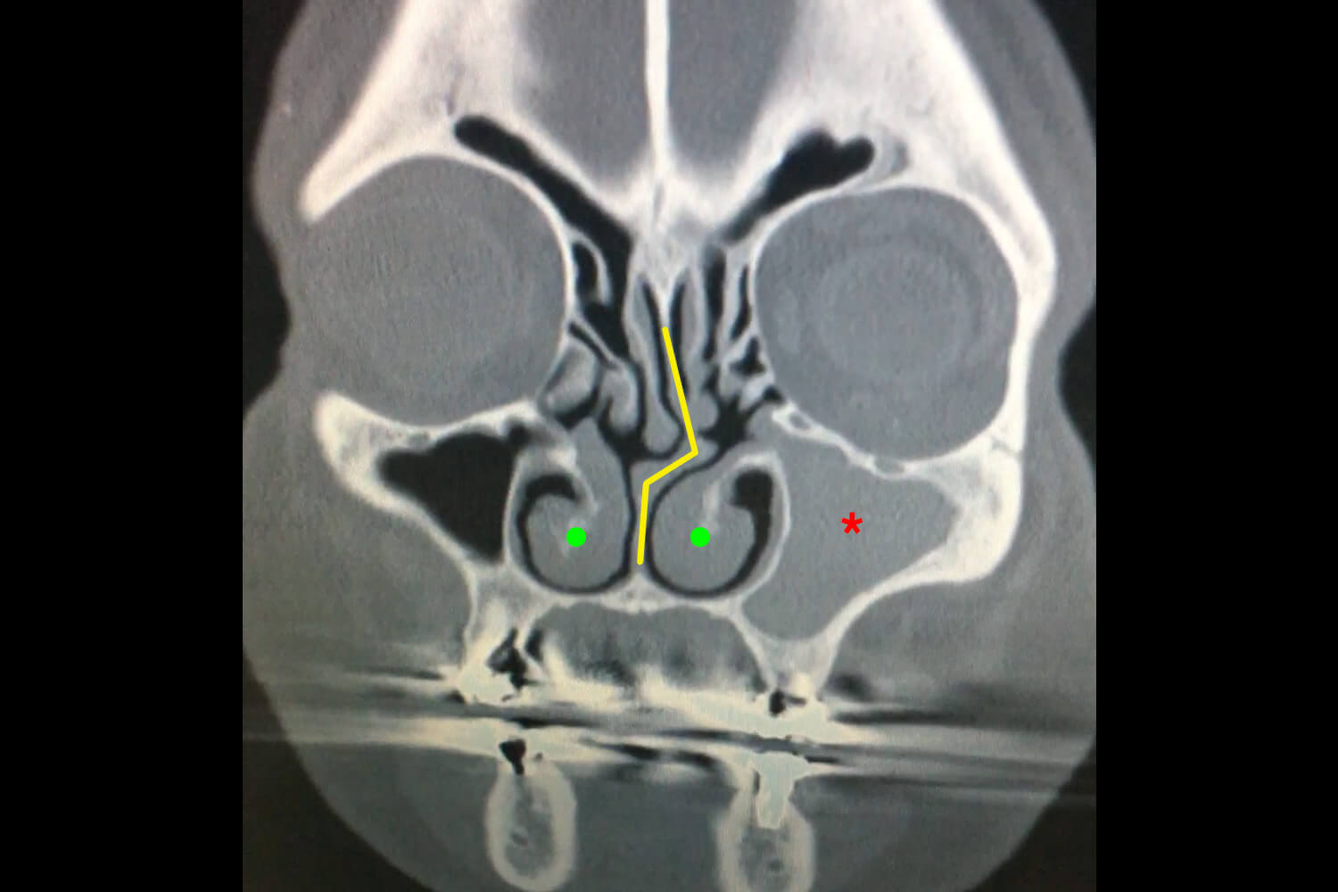sinusitis-septal-deviation-scan