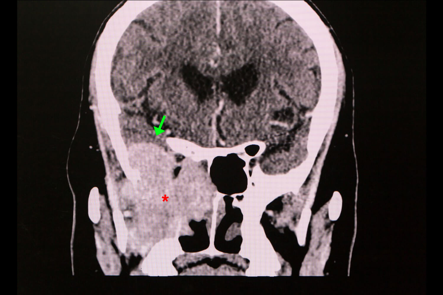 skull-base-tumor-scan