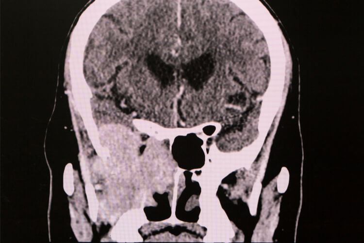 skull-base-tumor